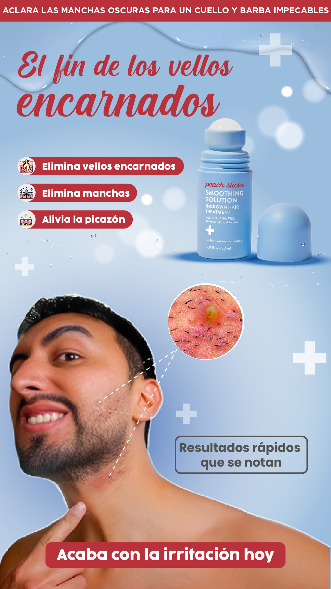 Peach slices| Elimina vellos encarnados al instante.